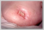 malignant cancerous wound
